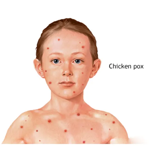 Varicella Zoster IgA (Chicken Pox)